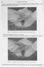 Fig. 23. Application d'une électrode olivaire sur le col de l'utérus / Fig. 24. Application d'une él [...]