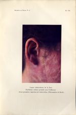 Pl VII. Lupus tuberculeux de la face. Erythème violacé produit sous l'influence d'une première injec [...]