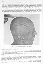 Fig. 5. Volet chirurgical sylvien du type moyen - Archives de Doyen. Revue médico-chirurgicale illus [...]