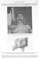 Fig. 8. Application de l'écarteur des commissures labiales / Fig. 9. Trépanation du sinus maxillaire [...]