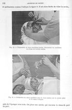 Fig. 10. Trépanation du sinus maxillaire gauche / Fig. 11. Perforation du sinus maxillaire dans la f [...]