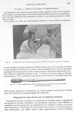 Fig. 12. Trépanation du sinus maxillaire gauche / Fig. 13. Tige supplémentaire servant d'allonge pou [...]