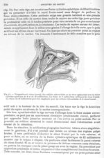 Fig. 14. Trépanation du sinus frontal, des cellules ethmoïdales et du sinus sphénoïdal avec la frais [...]