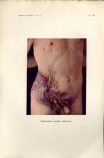 Planche XII. Tuberculose cutanée ulcéreuse - Archives de Doyen. Revue médico-chirurgicale illustrée