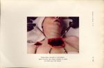 Planche XIII. Tuberculose sternale et claviculaire - Archives de Doyen. Revue médico-chirurgicale il [...]