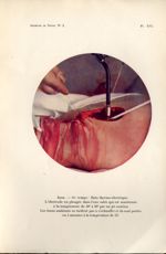 Planche XVI. 3 ème temps : Bain thermo-électrique - Archives de Doyen. Revue médico-chirurgicale ill [...]