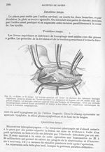 Fig. 11. Idem. 3ème temps - Archives de Doyen. Revue médico-chirurgicale illustrée