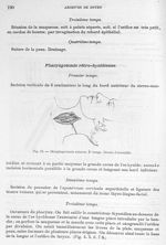 Fig. 13. Oesophagotomie externe - Archives de Doyen. Revue médico-chirurgicale illustrée