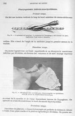 Fig. 16. L'opération est terminée : la muqueuse de l'oesophage a été suturée à la peau / Fig. 17. Oe [...]