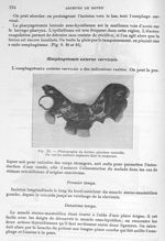 Fig. 20. Photographie du dentier, grandeur naturelle - Archives de Doyen. Revue médico-chirurgicale  [...]