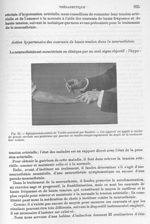 Fig. 25. Sphygmomanomètre de Verdin construit par Boulitte - Archives de Doyen. Revue médico-chirurg [...]