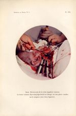 Planche XIX. idem. Découverte de la veine jugulaire interne - Archives de Doyen. Revue médico-chirur [...]