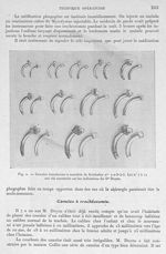Fig. 2. Canules tranchantes à mandrin de Krishaber - Archives de Doyen. Revue médico-chirurgicale il [...]