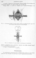 Fig. 9. Laryngotomie médiane. 3ème temps / Fig. 10. Extirpation d'un corps étranger sous-glottique p [...]