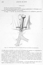 Fig. 13. Endoscopie directe de la bronche droite par une incision de trachéotomie - Archives de Doye [...]