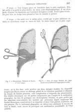 Fig. 5. Pleurotomie. Méthode de Doyen. 1er et 2ème temps / Fig. 6. Idem. 3 ème temps - Archives de D [...]