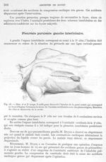 Fig. 23. Idem. 2ème et 3ème temps - Archives de Doyen. Revue médico-chirurgicale illustrée