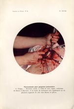 Planche XXVIII. Thoracotomie pour gangrène pulmonaire - Archives de Doyen. Revue médico-chirurgicale [...]