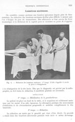Fig. 6. Réduction des luxations anciennes. 1er temps - Archives de Doyen. Revue médico-chirurgicale  [...]