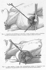 Fig. 4. Amputation intra-deltoïdienne du bras droit / Fig. 5. Même opération. 4ème temps. Plaie infu [...]
