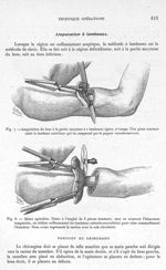Fig. 7. Amputation du bras à la partie moyenne à 2 lambeaux égaux, 2ème temps. Fg 8. Même opération  [...]