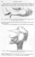 Fig. 9. Amputation du bras au tiers inférieur à lambeaux égaux / Fig. 10. Même opération. Aspect de  [...]
