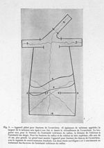 Fig. 5. Appareil plâtré pour fractures de l'avant-bras - Archives de Doyen. Revue médico-chirurgical [...]