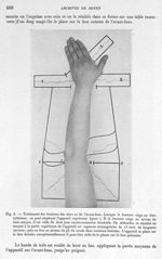 Fig. 6. Traitement des fractures des deux os de l'avant-bras - Archives de Doyen. Revue médico-chiru [...]