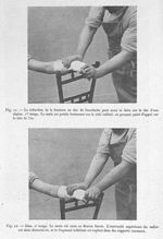 Fig. 11. La réduction de la fracture en dos de fourchette peut aussi se faire sur le dos d'une chais [...]