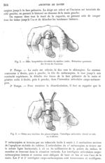 Fig. 5. Idem. Amputation circulaire du médius / Fig. 6. Grâce aux tractions des pinces-érignes, l'in [...]