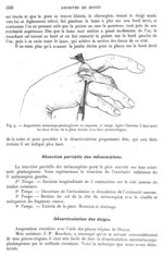 Fig. 9. Amputation métacarpo-phalangienne en raquette. 2ème temps - Archives de Doyen. Revue médico- [...]