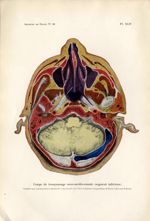 Planche XLIV. Coupe de tronçonnage sous-médio-nasale - Archives de Doyen. Revue médico-chirurgicale  [...]