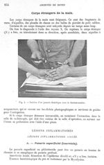 Fig. 4. Incision d'un panaris diabétique avec le thermo-cautère - Archives de Doyen. Revue médico-ch [...]