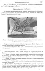 Fig. 7. Dissection de la grande synoviale palmaire atteinte de synovite à grains riziformes - Archiv [...]