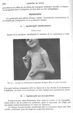 Fig. 10. Exemple de malformations congénitales multiples. Mains en pince d'écrevisse - Archives de D [...]