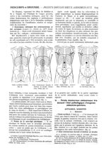 Fig. 9. - Point vertébral (Vidal) / Fig. 10. - Zone douloureuse dorsale et douleur en broche (Trouss [...]