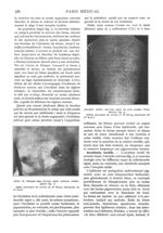 Fig. 1. - Ulcère de Röntgen aigu, survenu après examens radiologiques. Cliché provenant du service d [...]