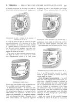 Fig. 1. - Enfouissement du globe : incision de la muqueuse et placement des fils / Fig. 2. - Enfouis [...]