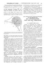 Fig. 6. - Schéma d'un cancer du sein sur une coupe transversale du thorax - Paris médical : la semai [...]