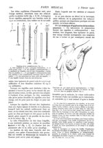 Fig. 1. - Outillage de la radiumpuncture / Fig. 2. - Carcinome du sein traité par la radiumpuncture  [...]