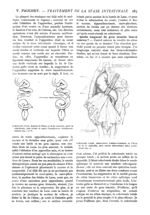 Fig. 7. et 8. - Colectomie totale. Aspect de l'iléon et de la sigmoïde, après la colectomie, puis av [...]