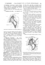 Fig. 12. - Anastomose iléo-sigmoïdienne avec bouton de Villar / Fig. 13. - Anastomose iléo-sigmoïdie [...]