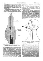 Fig. 1. - Inclusion de deux tubes de radium au centre de la tumeur oesophagienne sous contrôle de l' [...]