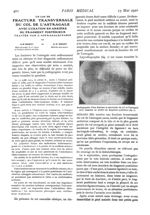 Fig. 1. - Radiographie d'une fracture transversale du col de l'astragale avec luxation en arrière du [...]