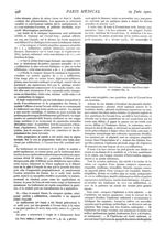 Fig. 2. - Dermo-épidermite microbienne strepto-staphylococcique en carapace - Paris médical : la sem [...]