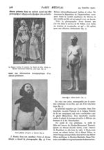Fig. 2. - La femme barbue et enceinte du Musée de Bâle (Nielle de Nicolas Emmanuel Deutsch, 1484-153 [...]