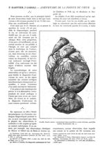Fig. 4. - Dessin, d'après nature, représentant l'anévrysme de la pointe du coeur, après dissection d [...]