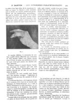 Fig. 2 Le signe de Trousseau ou provocation de la contracture de la main et des doigts sous l'influe [...]