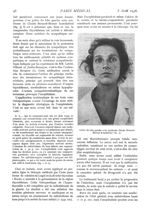 Fig. 3. - Goitre du lobe gauche avec syndrome Claude Bernard-Horner homolatéral - Paris médical : la [...]
