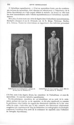 Infantilisme myxoedémateux ; garçon de 18 ans (cas de Brissaud) / Infantilisme du type Lorrain, jeun [...]